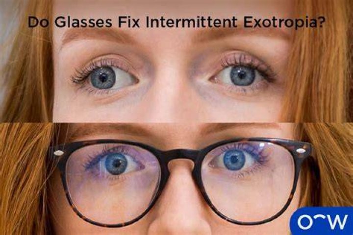 Can intermittent exotropia go away?