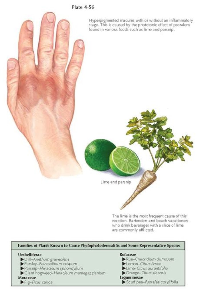Can Lemon cause phytophotodermatitis?
