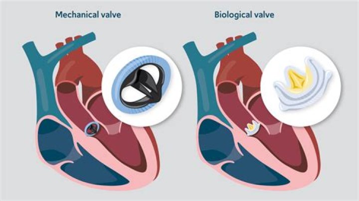 Can you have two bicuspid valves?