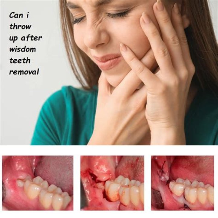 How long after wisdom teeth removal can I diet normal?