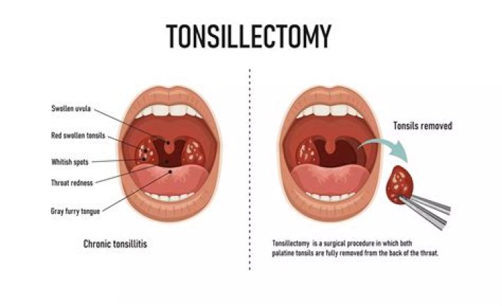Is fever normal after tonsillectomy?