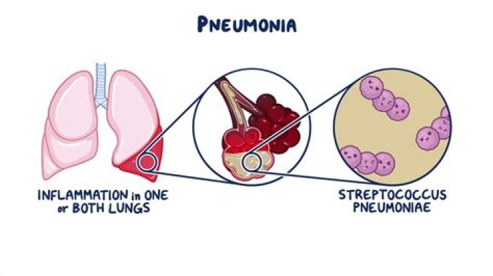 Is pneumococcal same as pneumonia?