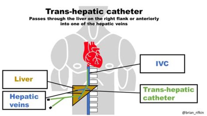 What is a transhepatic catheter?
