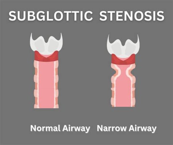 What is subglottic stenosis?