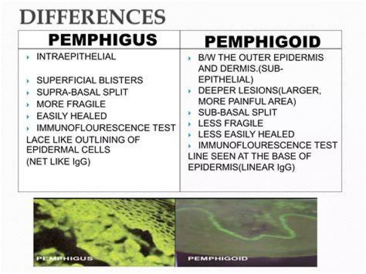 What is the difference between pemphigoid and pemphigus?
