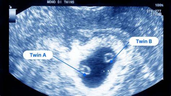 When does twin pregnancy become uncomfortable?